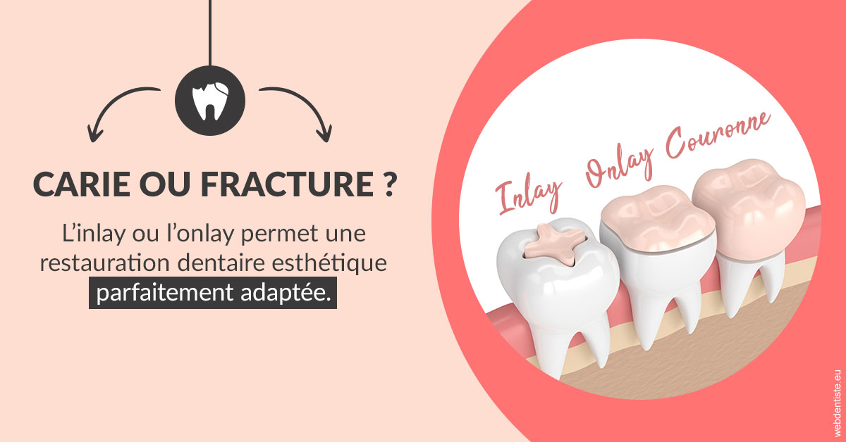 https://dr-blanchard-patrick-yves.chirurgiens-dentistes.fr/T2 2023 - Carie ou fracture 2