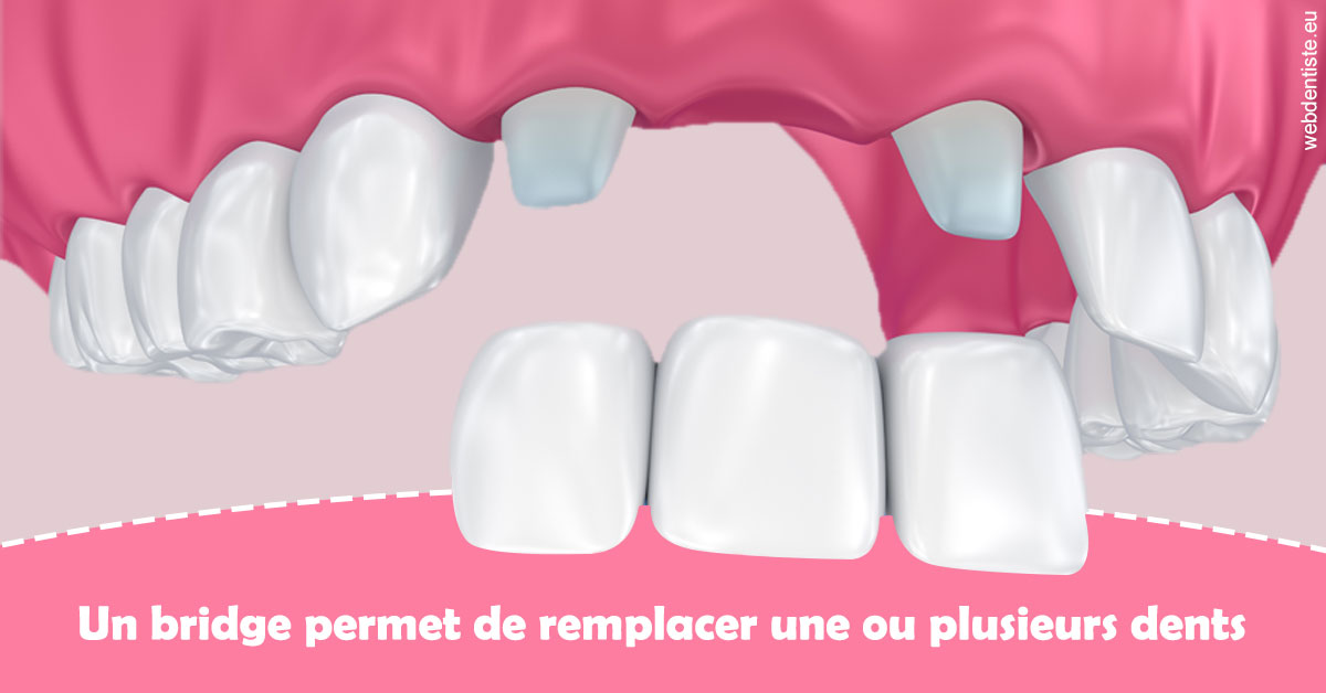 https://dr-blanchard-patrick-yves.chirurgiens-dentistes.fr/Bridge remplacer dents 2