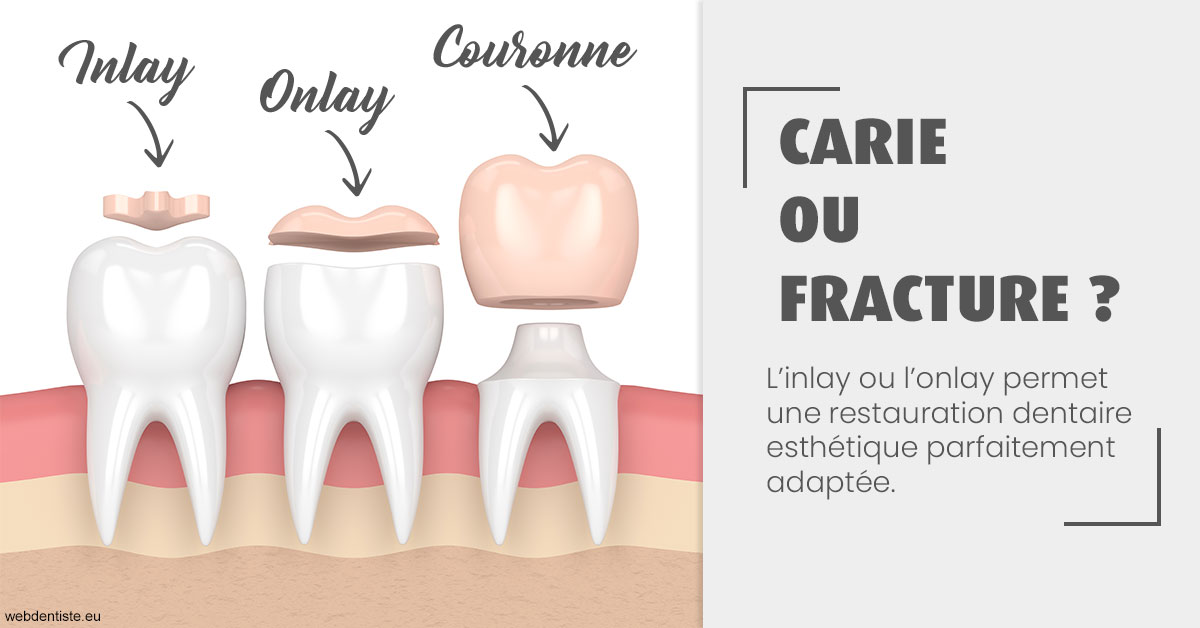 https://dr-blanchard-patrick-yves.chirurgiens-dentistes.fr/T2 2023 - Carie ou fracture 1