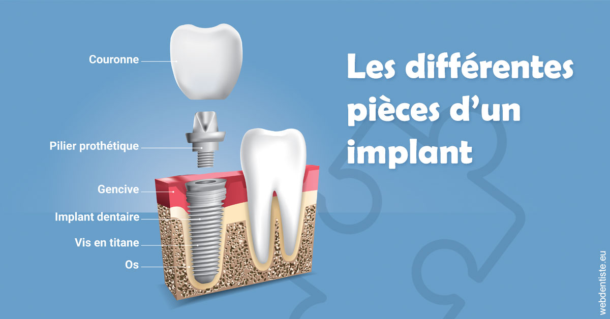 https://dr-blanchard-patrick-yves.chirurgiens-dentistes.fr/Les différentes pièces d’un implant 1